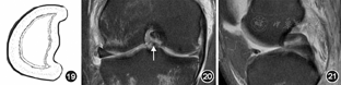 点击查看大图 图19～21 图19为半月板桶柄状撕裂示意图;冠状位质子