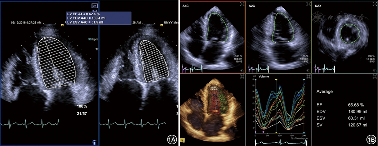 点击查看大图 图1 二维simpson法(图1a)与三维超声心动图测量的左