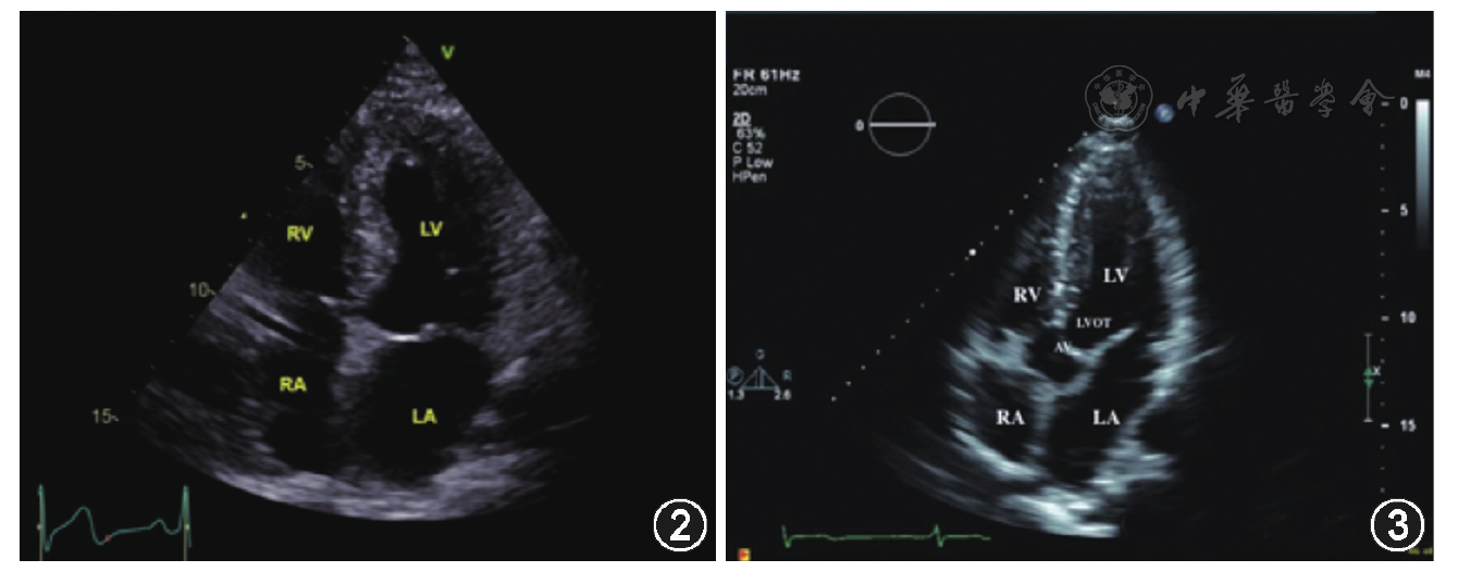点击查看大图 图2 心尖四腔心切面超声图像 图3 心尖五腔心切面超声