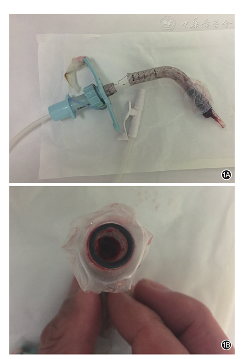 警惕吸痰通畅时气管套管的堵塞