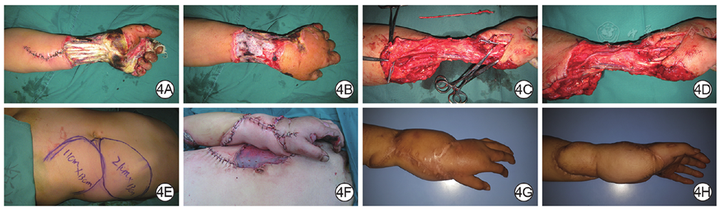 图4 腹部联合轴型皮瓣修复例4患者左腕部环状高压电烧伤创面.4a.
