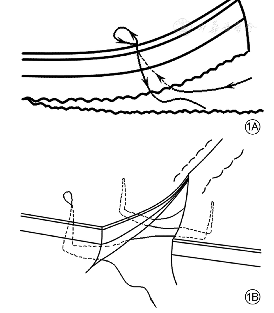 图1 章氏超减张缝合示意图.1a.截面图,距创缘1.0～1.
