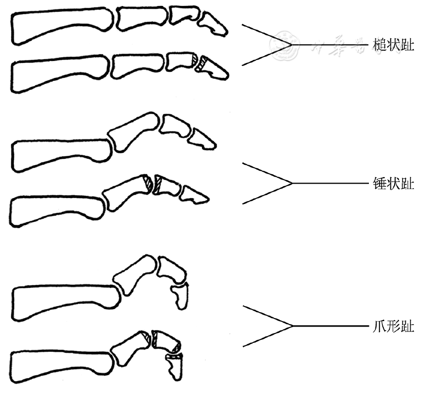 注:阴影示切除部分     "槌状趾","锤状趾","爪形趾"畸形(上)及手术