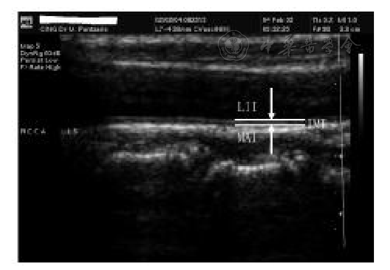 基于深度学习的颈动脉超声图像内中膜厚度测量