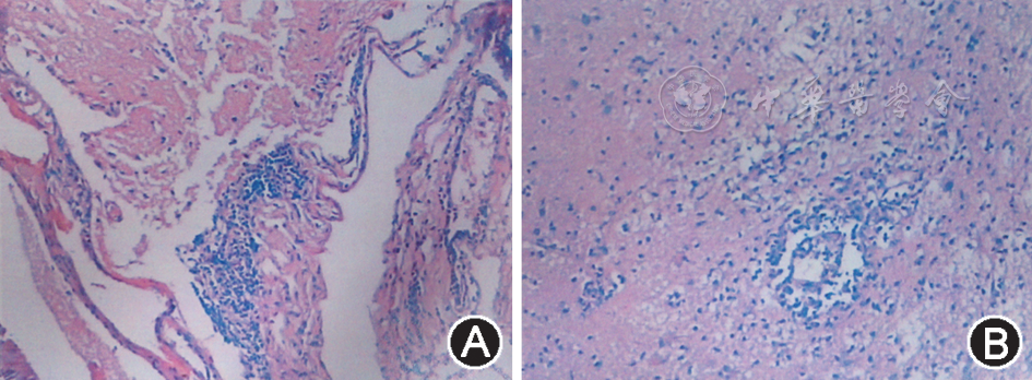 图3 患者右额叶石蜡切片病理学检查结果示:镜下见蛛网膜有较多淋巴