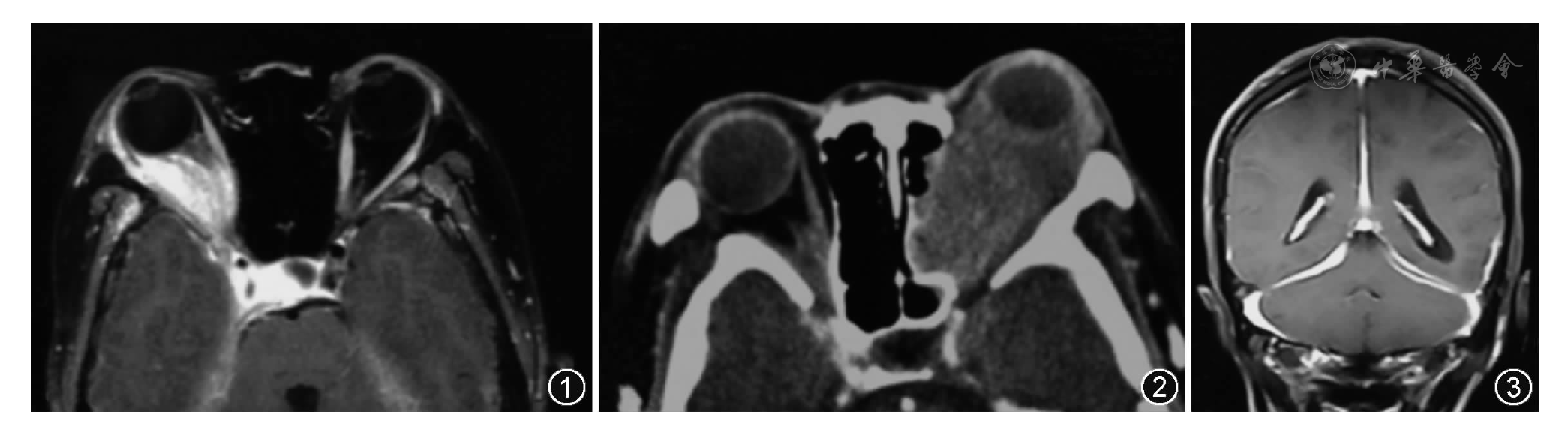 肥厚性硬脑膜炎伴双眼眶炎性假瘤一例