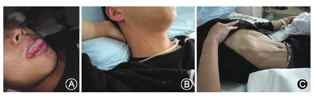 图1 患者入院时体格检查,见舌缘多发溃疡(a,右侧颈部浅表静脉曲张(b)