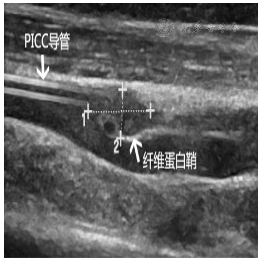 一例白血病患儿纤维蛋白鞘包裹picc引起拔管困难的护理