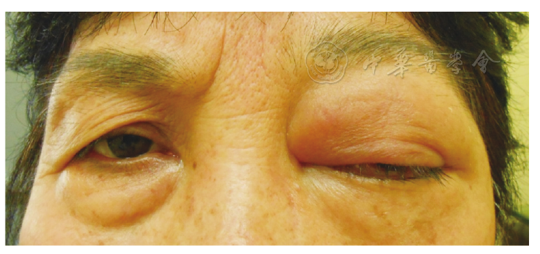 以眼睑及结膜红肿起病的眼眶弥漫性b细胞淋巴瘤一例