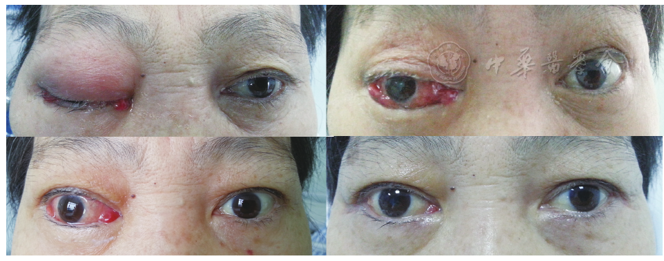 自发性眼眶血肿和眶蜂窝织炎二例