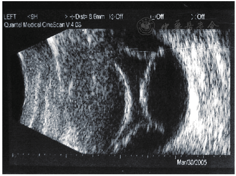 图2 "脉络膜上腔放液术"后第二天右眼b超:环形分叶状脉络膜脱离隆起