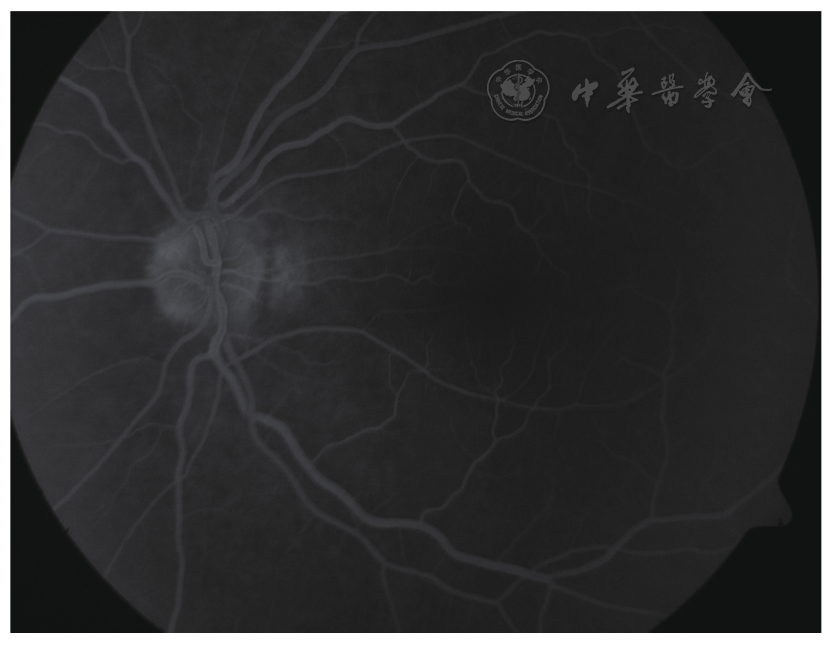 oct联合ffa对埋藏性视盘玻璃膜疣诊断价值