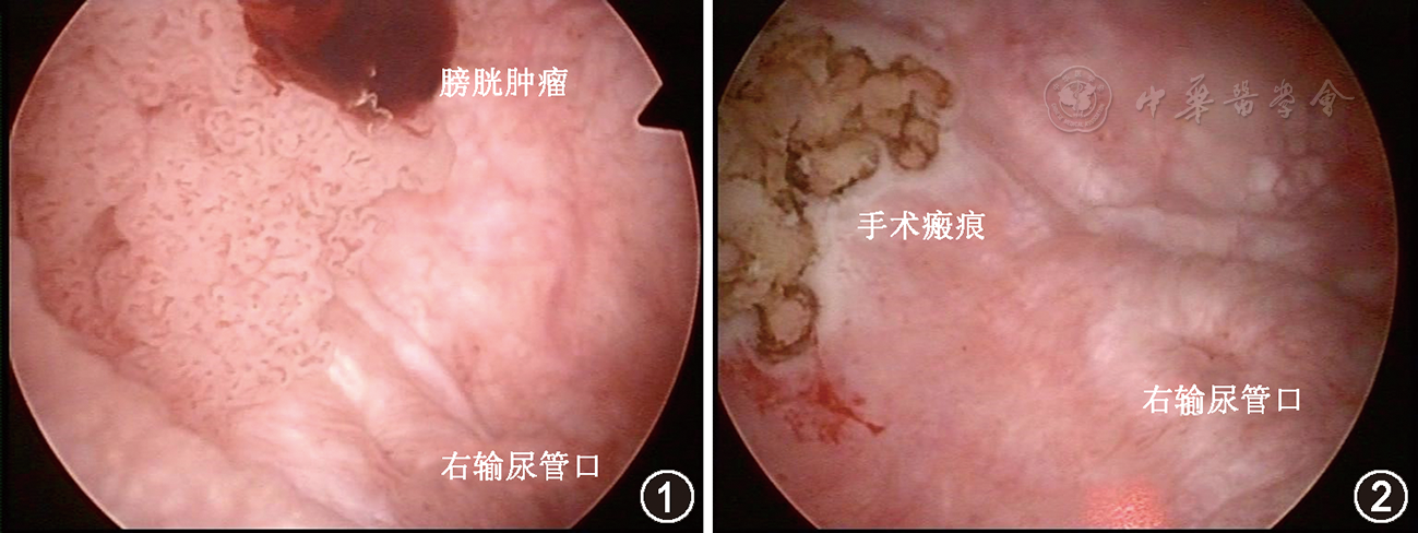 2μm激光膀胱肿瘤剜除术治疗乳头状尿路上皮癌