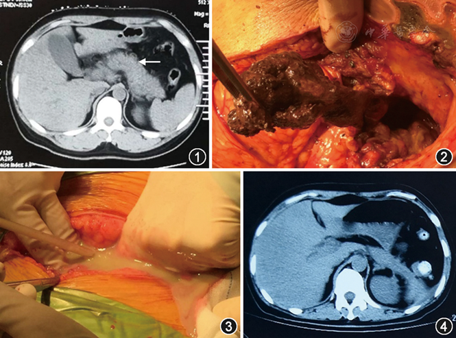 图1～4 重症急性胰腺炎合并十二指肠瘘患者影像学检查及手术相关图片