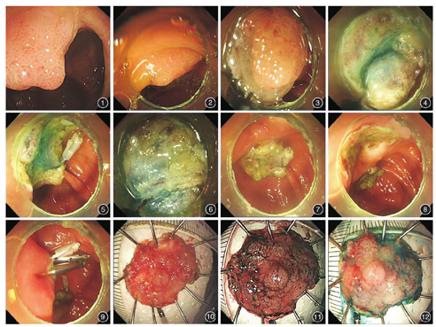 金属钛夹固定法辅助内镜治疗回盲瓣侧向发育型肿瘤一例