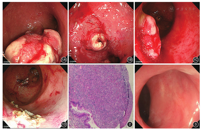 溃疡性结肠炎合并巨大息肉内镜黏膜下剥离术一例