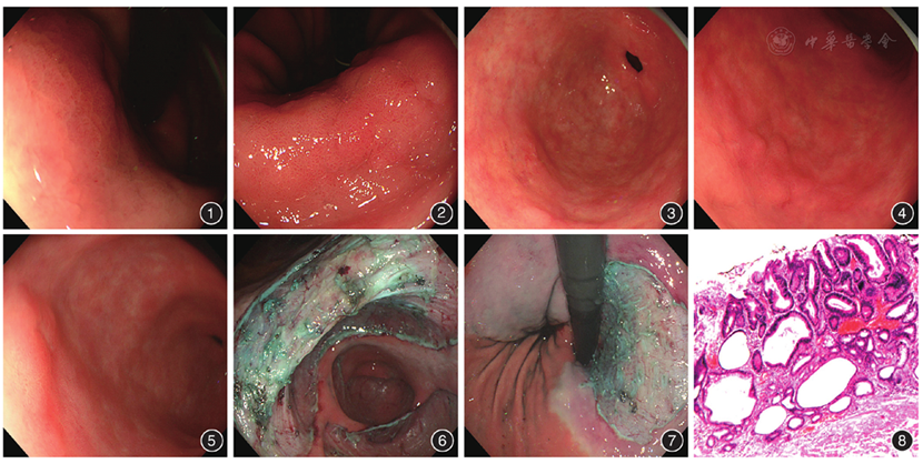 胃镜诊治同时性五源发早期胃癌一例