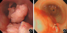 儿童食管乳头状瘤合并喉乳头状瘤一例