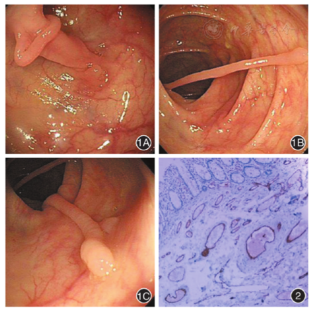 图1 肠镜检查于横结肠近脾区距肛门43 cm处见3枚长蒂息肉,呈细条索状