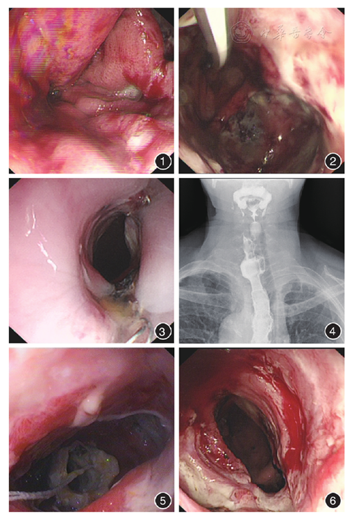 图1 胃镜检查,见食管癌术后吻合口瘘瘘口开口 图2 内镜下螺旋型鼻