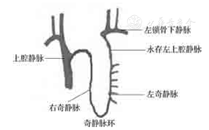 三度房室传导阻滞合并双奇静脉畸形植入永久起搏器一例