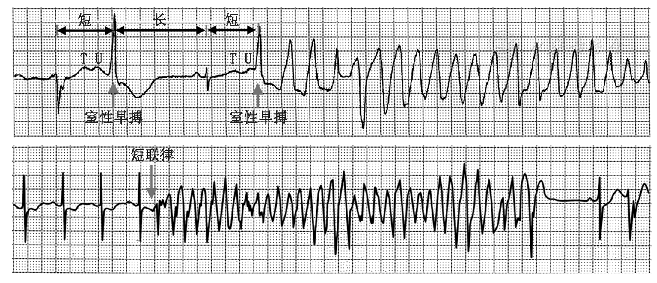 而引发一般的多形性室速的室早多数为短联
