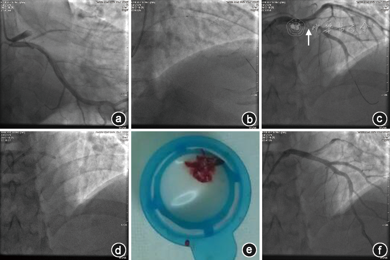 采用5 f子导管抽吸冠状动脉内顽固性血栓三例