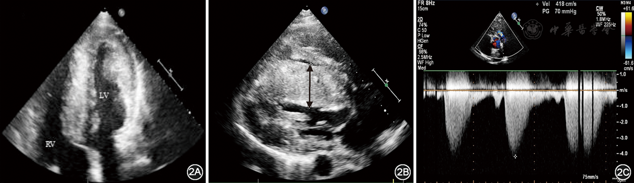 伴右心室流出道狭窄的梗阻性肥厚型心肌病一例