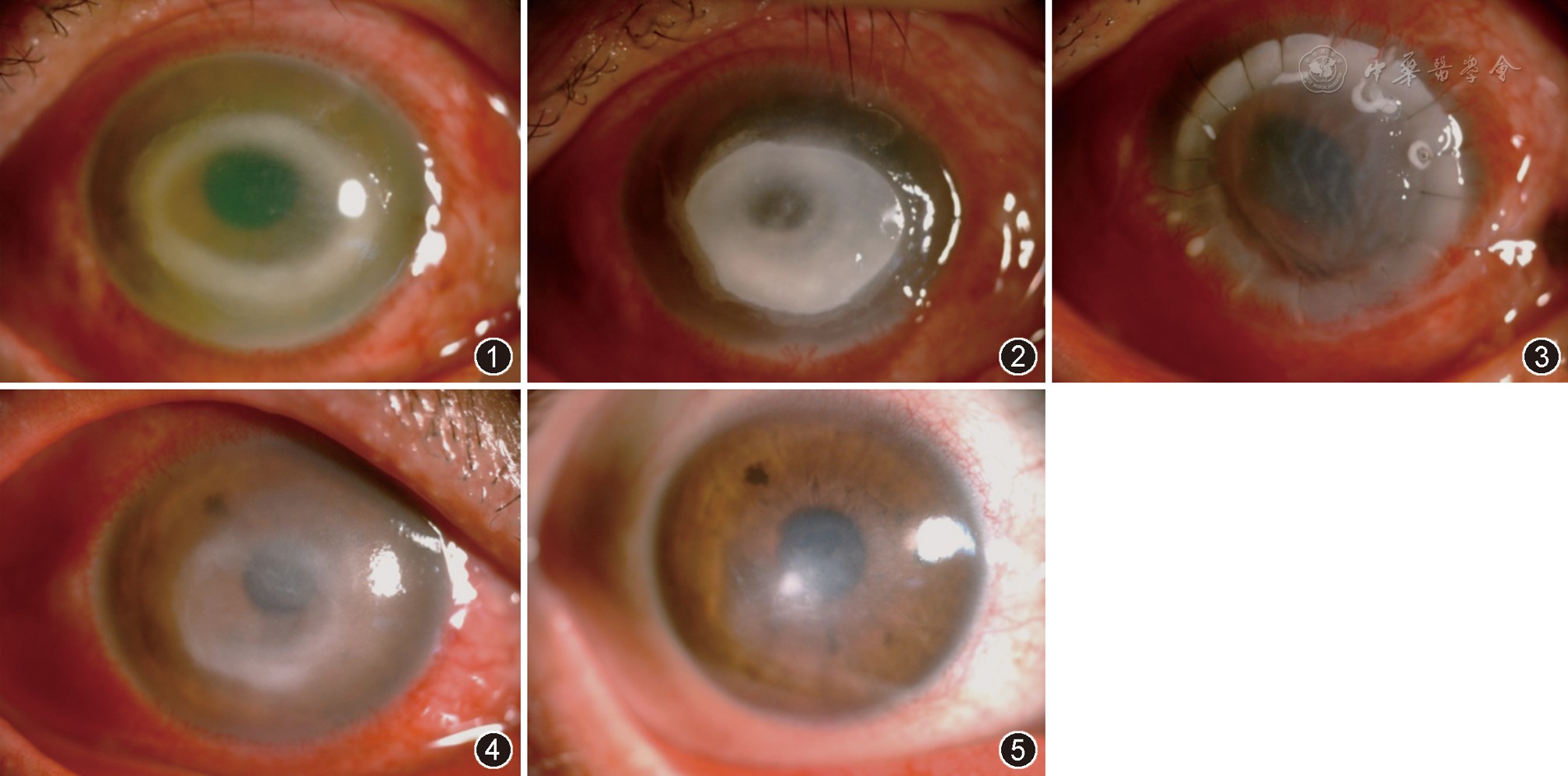 上皮大片缺损,角膜后沉积物( ),前房闪光(–),前房无积脓 图2 左眼