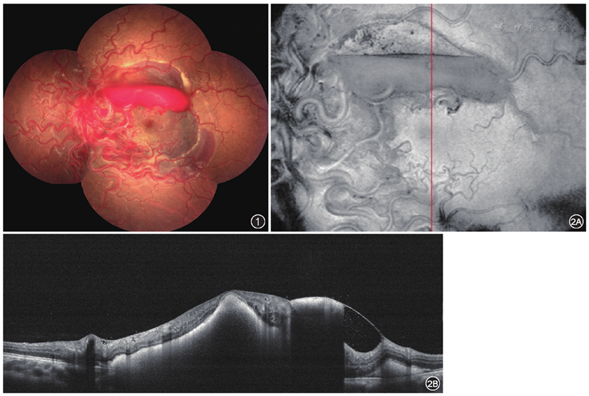 视网膜蔓状血管瘤合并黄斑出血