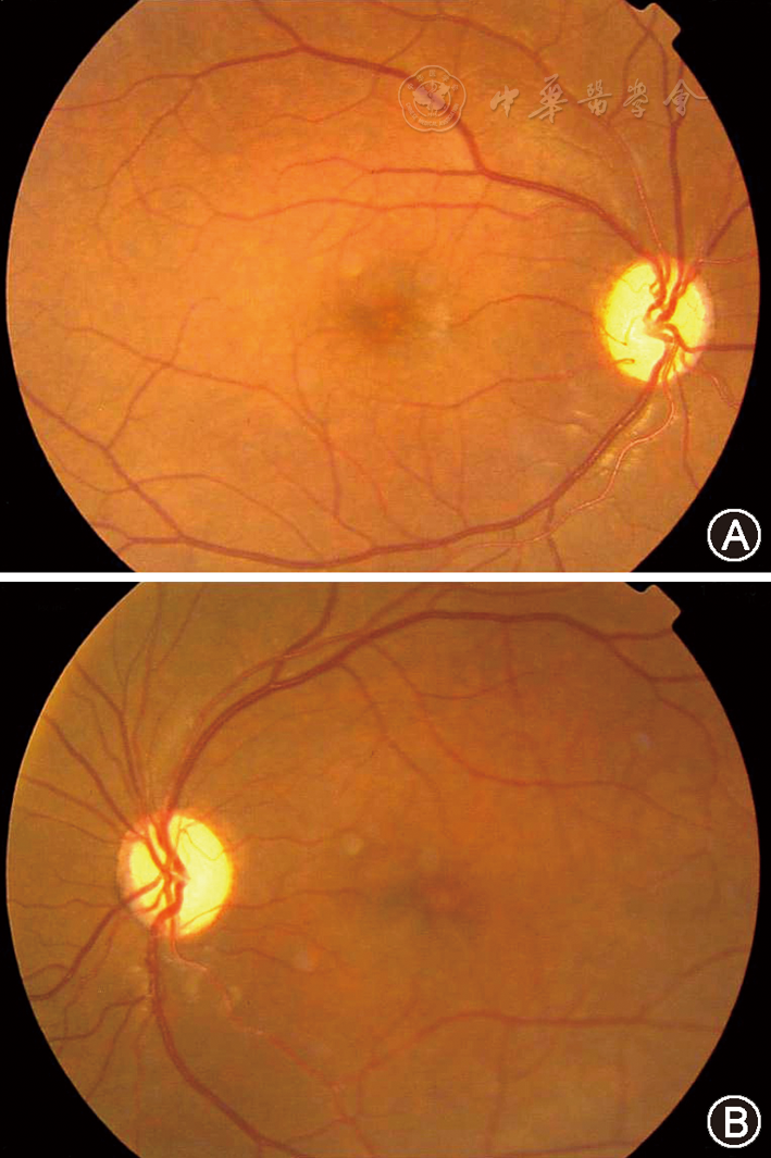 图1 双眼视物不清10年患者双眼底彩色图像,可见视神经萎缩,视网膜动脉
