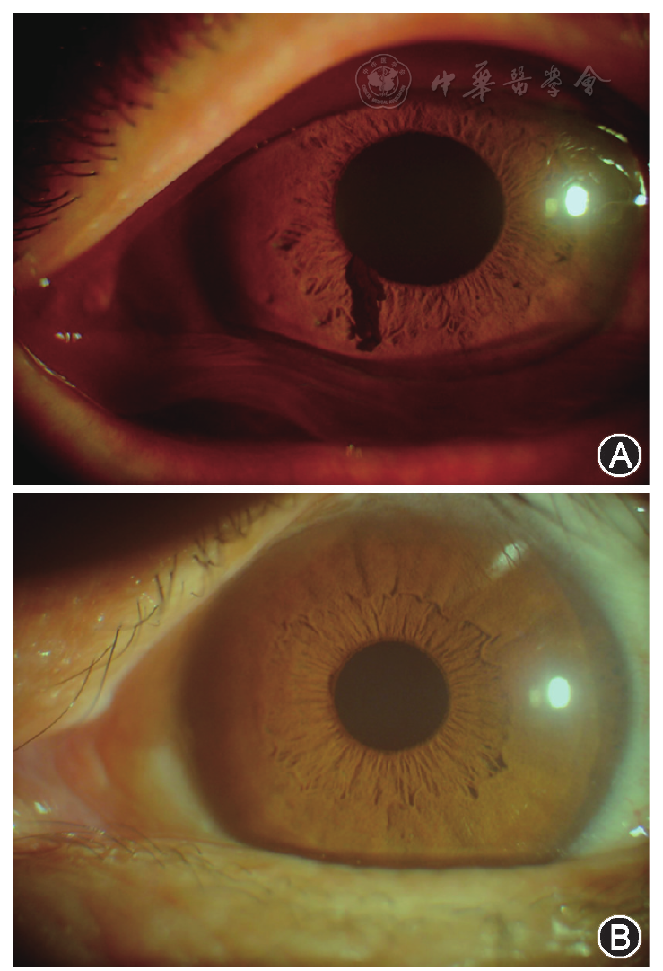虹膜色素上皮损伤伴部分脱落一例