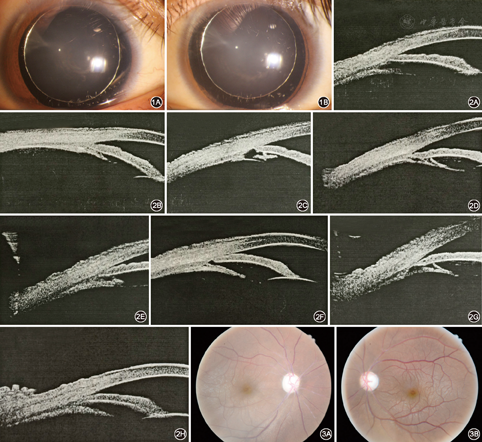 ubm示双眼前房略浅,窄房角,睫状突形态异常,右眼前房中央深度1.