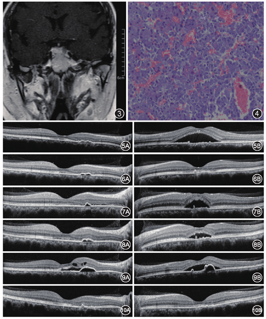 首诊为中心性浆液性脉络膜视网膜病变的垂体腺瘤一例
