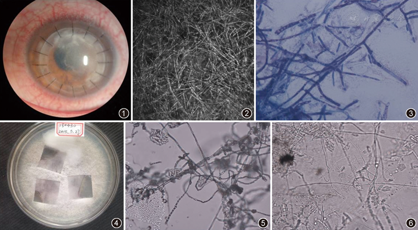 圆锥角膜术后佩戴绷带型角膜接触镜伴发串珠镰刀菌性角膜炎一例