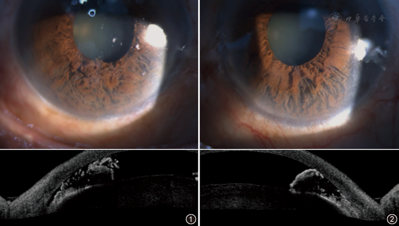 上图为采用裂隙灯检查法观察右眼前节,可见虹膜下方及鼻侧中断,萎缩脱