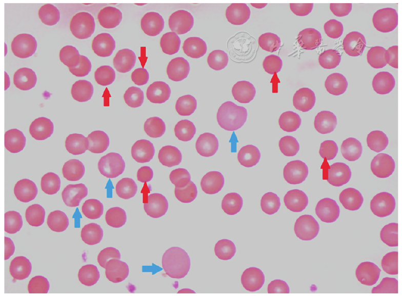 点击查看大图 图2 血涂片中球形红细胞(红色箭头)表现为密集的球状红