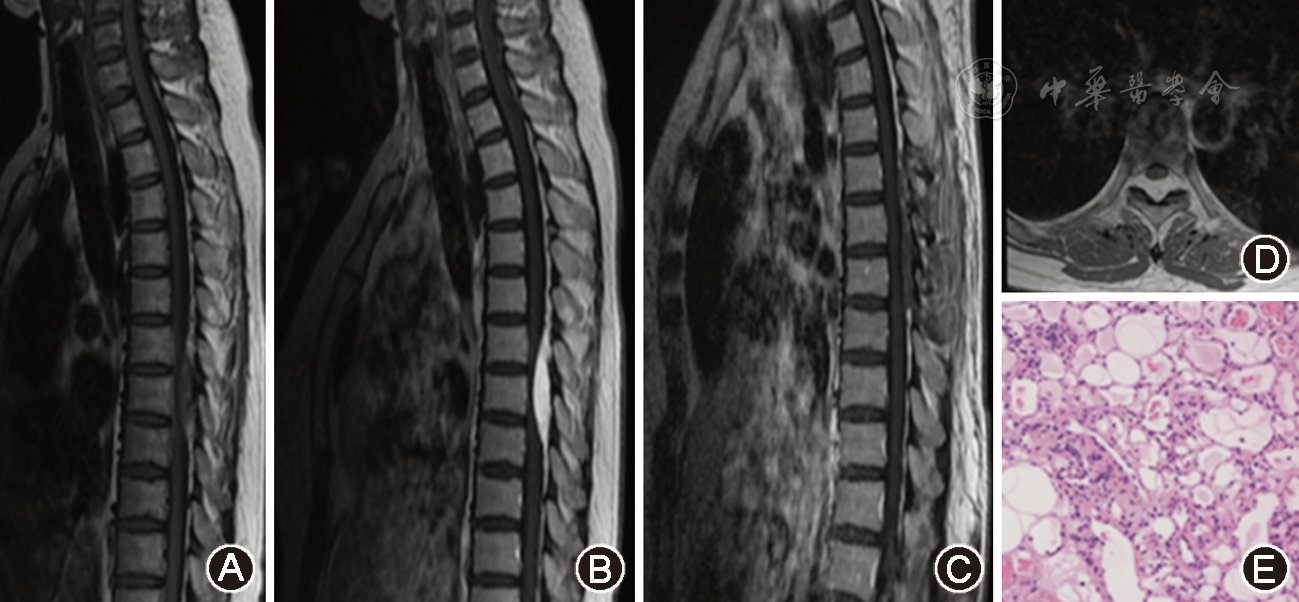 颈胸段椎管内脂肪瘤分类及手术治疗