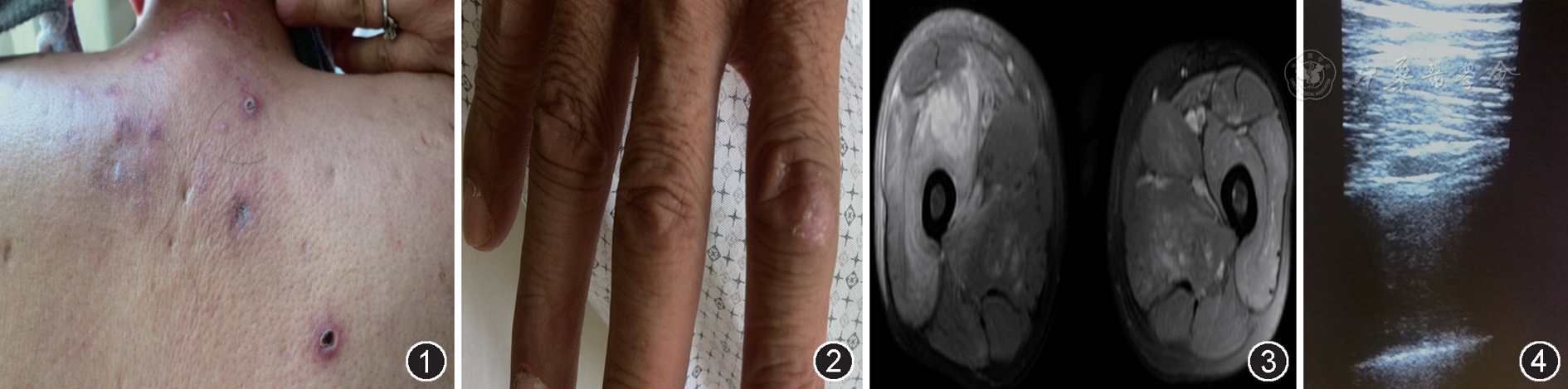 图1 皮肌炎合并肌肉血肿患者后背广泛毛囊炎样皮疹 图2 近端指间关节