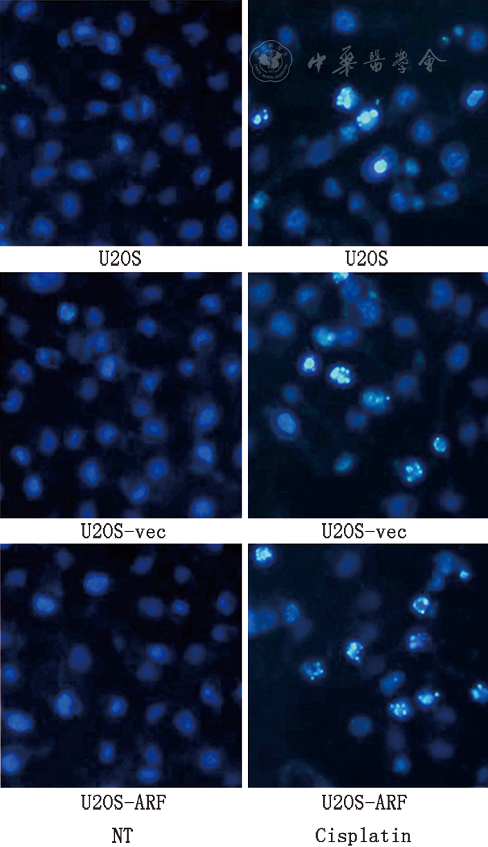 图2 hoechst33258荧光染色分析p14arf对顺铂诱导u2os细胞凋亡的影响