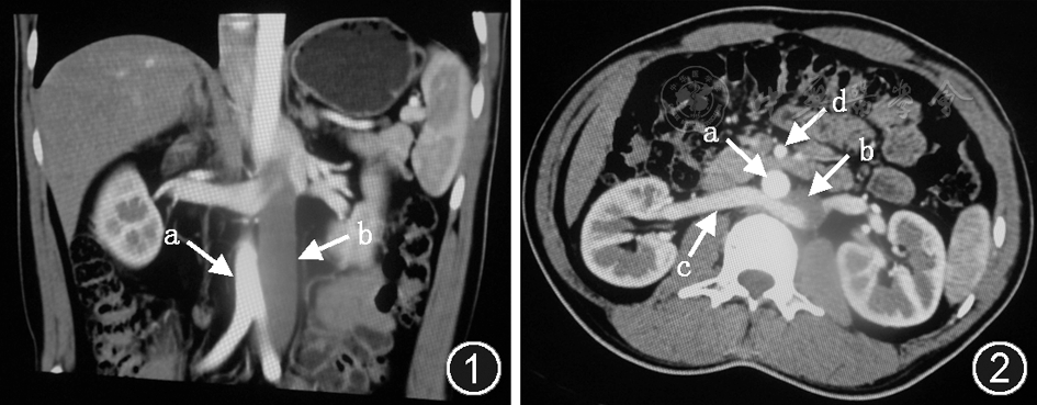 b 位于左侧的下腔静脉 图2 腹部ct右肾静脉水平横切面图  a 位于右侧