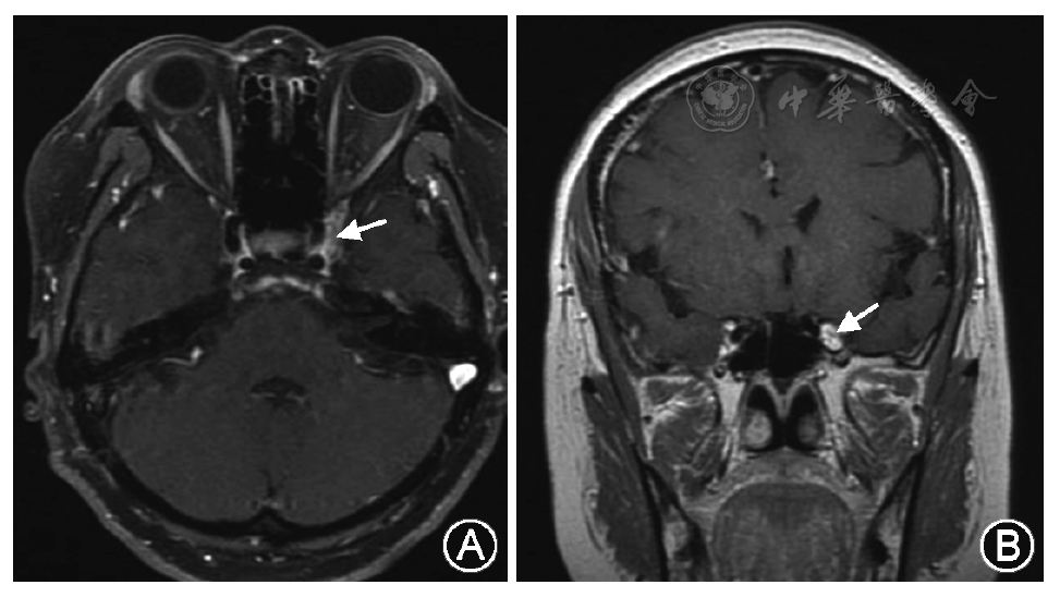 水平(a)及冠状位(b)mri t 1增强扫描可见左侧海绵窦条状强化(白色箭头