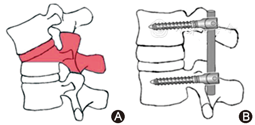 胸腰椎陈旧性骨折伴后凸畸形成人脊柱侧凸委员会schwabⅣ级截骨矫形的
