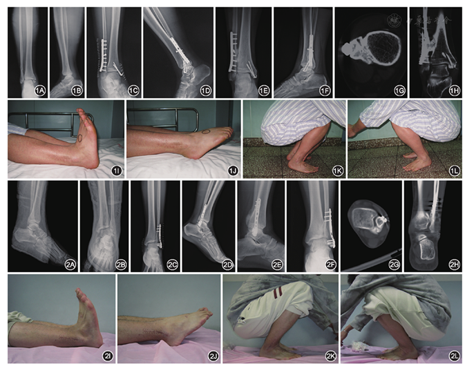 骨折术后胫腓远端骨性连接的影像学特点及其对踝关节活动度的影响