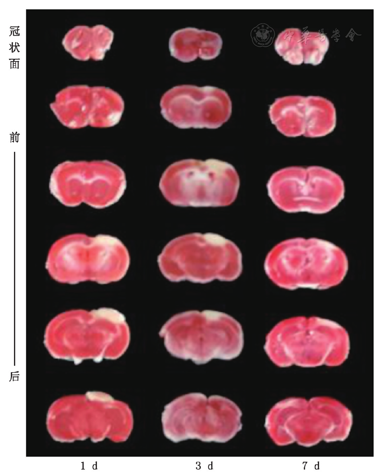 图5 小鼠脑切片ttc染色观察缺血梗死灶,皮质白色示梗死区域ttc:2,3,5