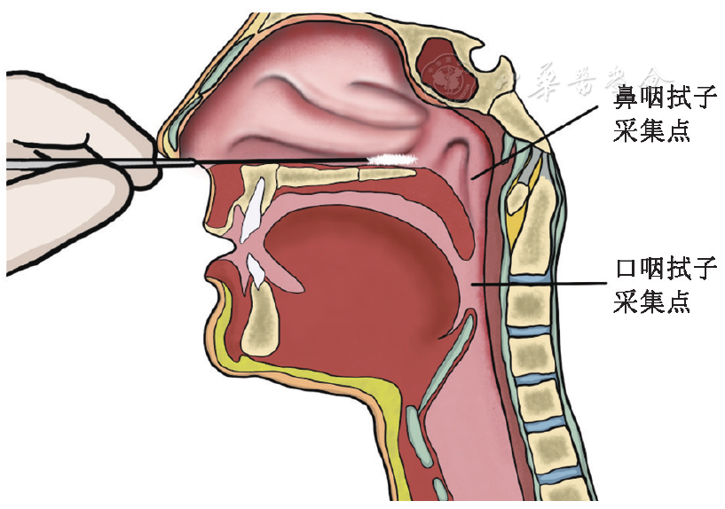 点击查看大图 图1 鼻咽拭子采集示意图 图1 鼻咽拭子采集示意图