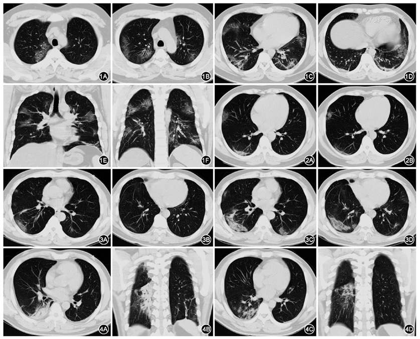 33例新型冠状病毒感染患者的肺部ct影像学分析
