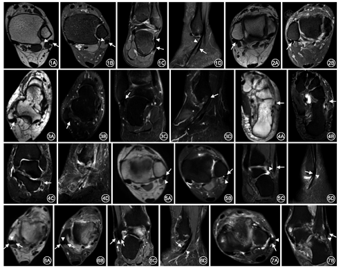 长肌腱及腓骨短肌腱正常磁共振表现:男,22岁,磁共振(mri)踝关节轴位t