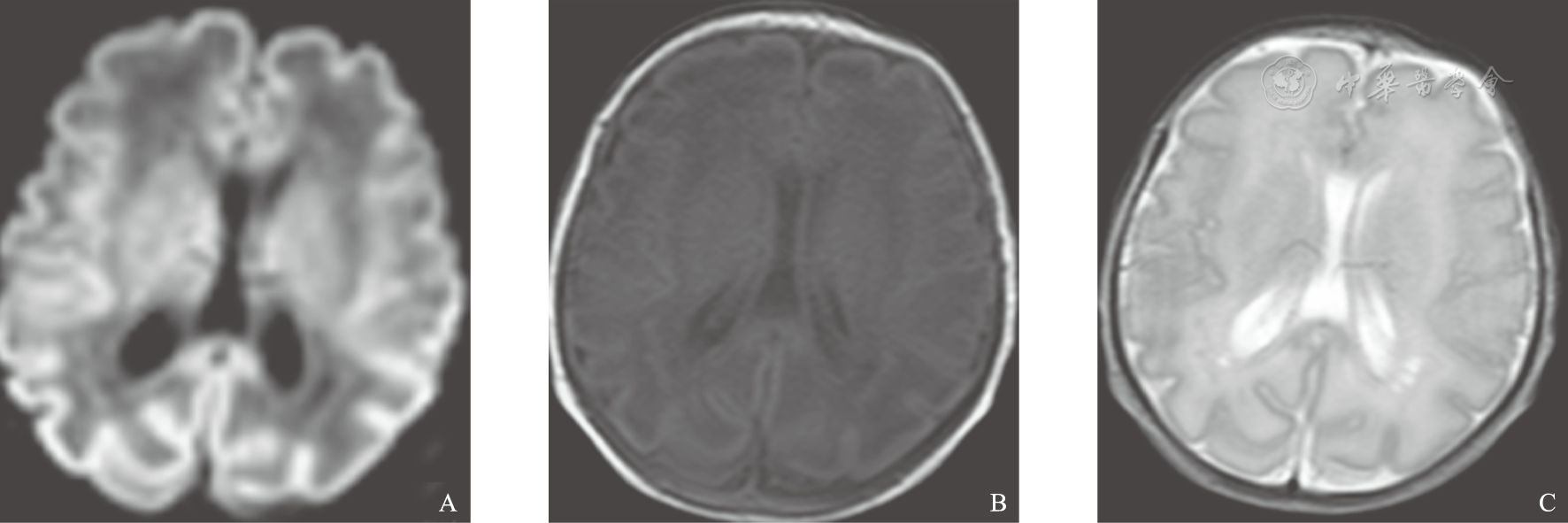 脑室周围白质软化早产儿出生早期mri表现及其演变