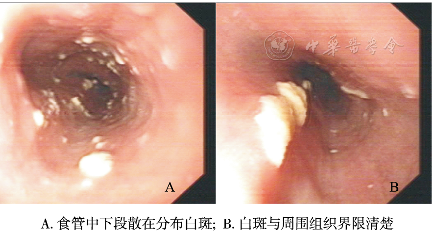 真菌性食管炎一例